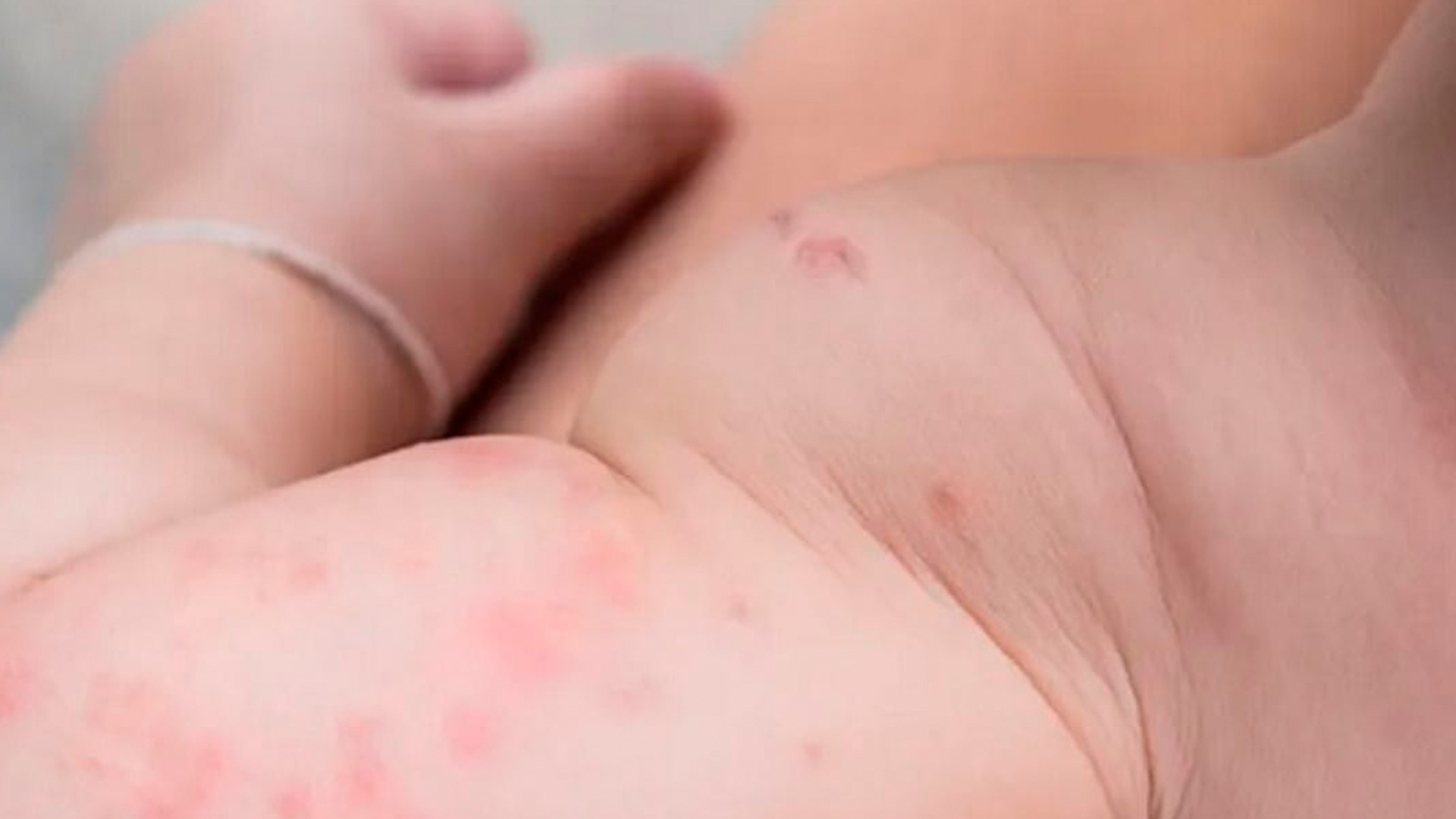 ¿Su bebé tiene cólicos, problemas en la piel o reflujo?: consultas gratuitas para detectar la alergia a la leche de vaca