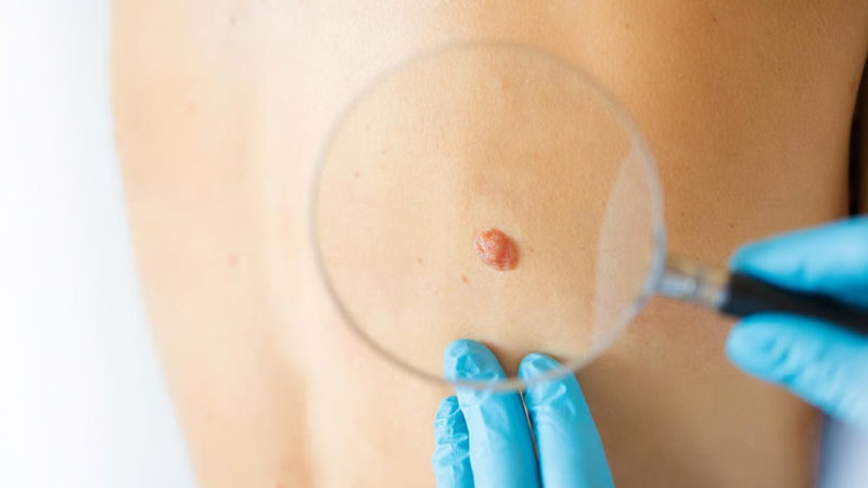 Una vacuna personalizada contra el cáncer redujo un 42% el riesgo de recaída del melanoma