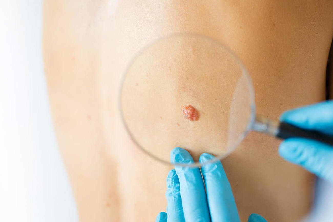 Una vacuna personalizada contra el cáncer redujo un 42% el riesgo de recaída del melanoma