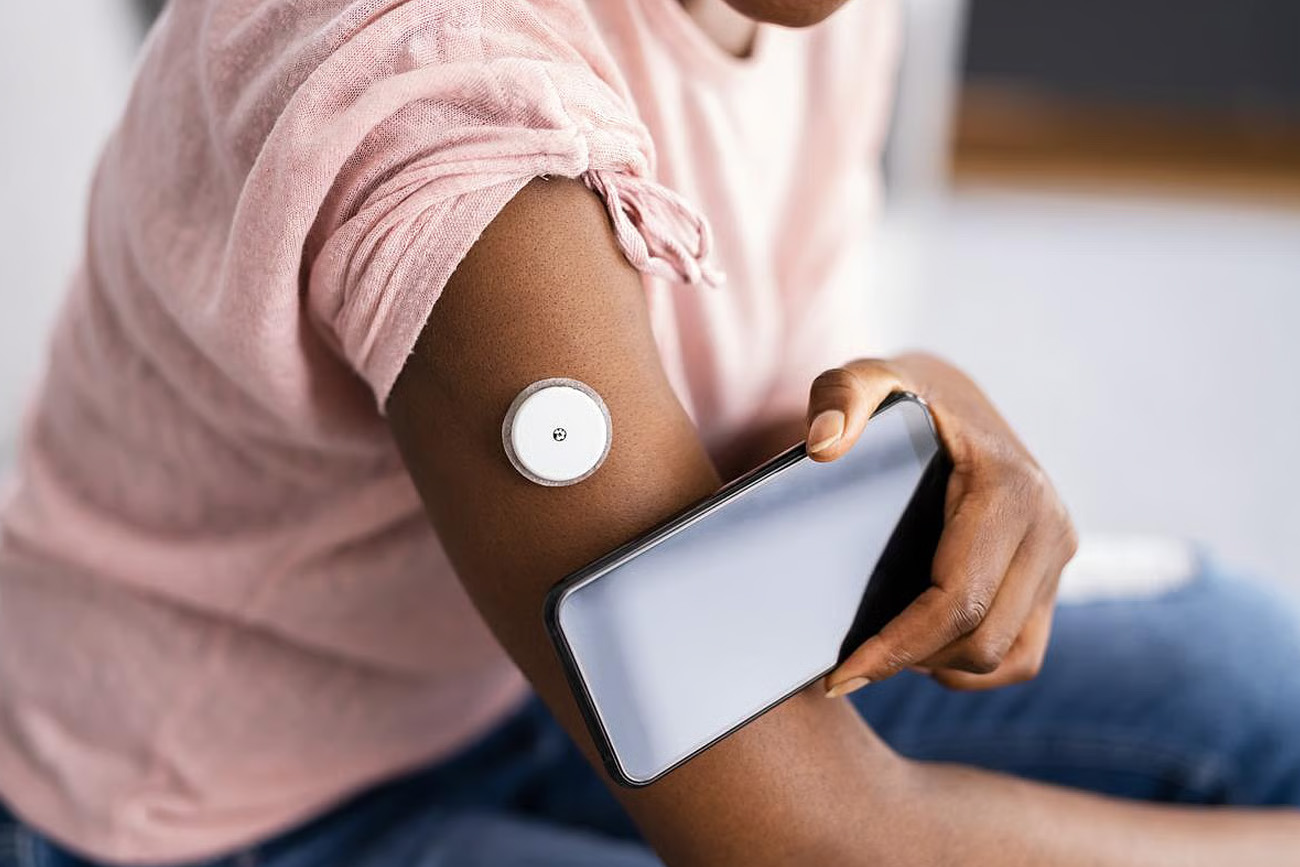 Los monitores continuos de glucosa podrían mejorar el control de la diabetes tipo 2 sin necesidad de insulina